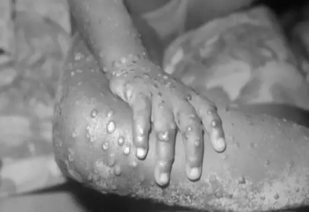 OMS: Variola maimuţei nu este o urgenţă sanitară globală